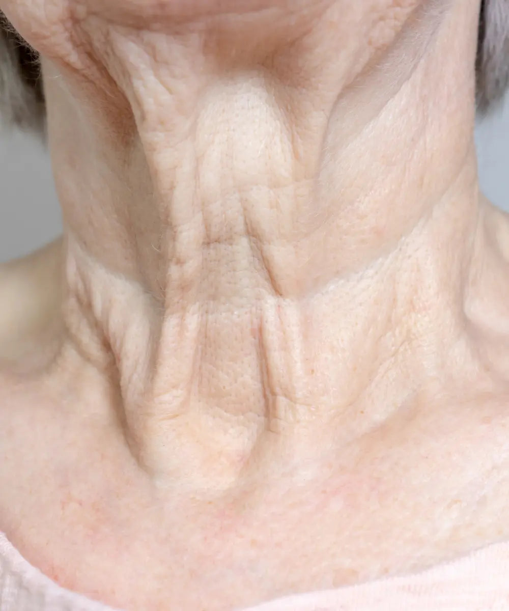 crepey-skin-example.webp