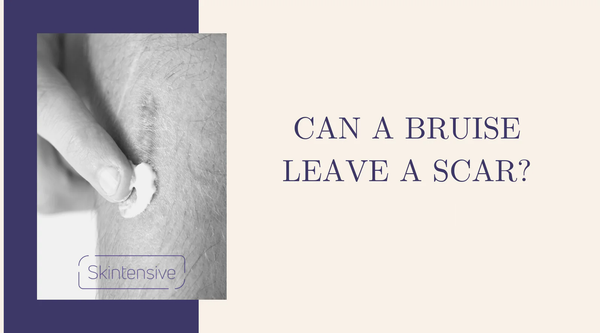 Can Bruises Scar?