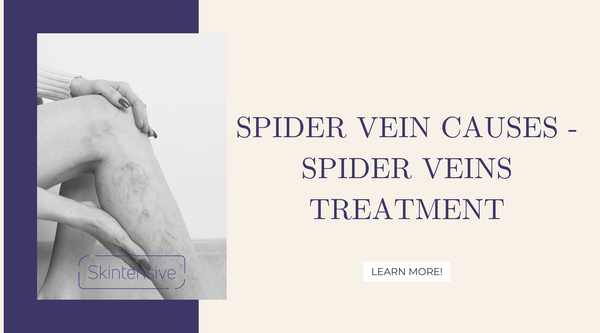 Spider Vein Causes - Spider Veins Treatment