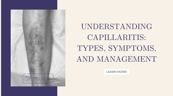 Understanding Capillaritis: Types, Symptoms, and Management