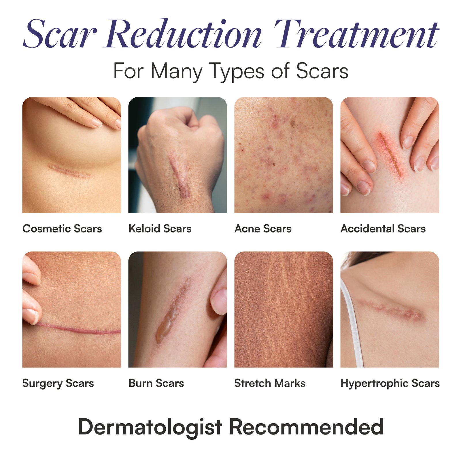 Silicone sheets for scars discount