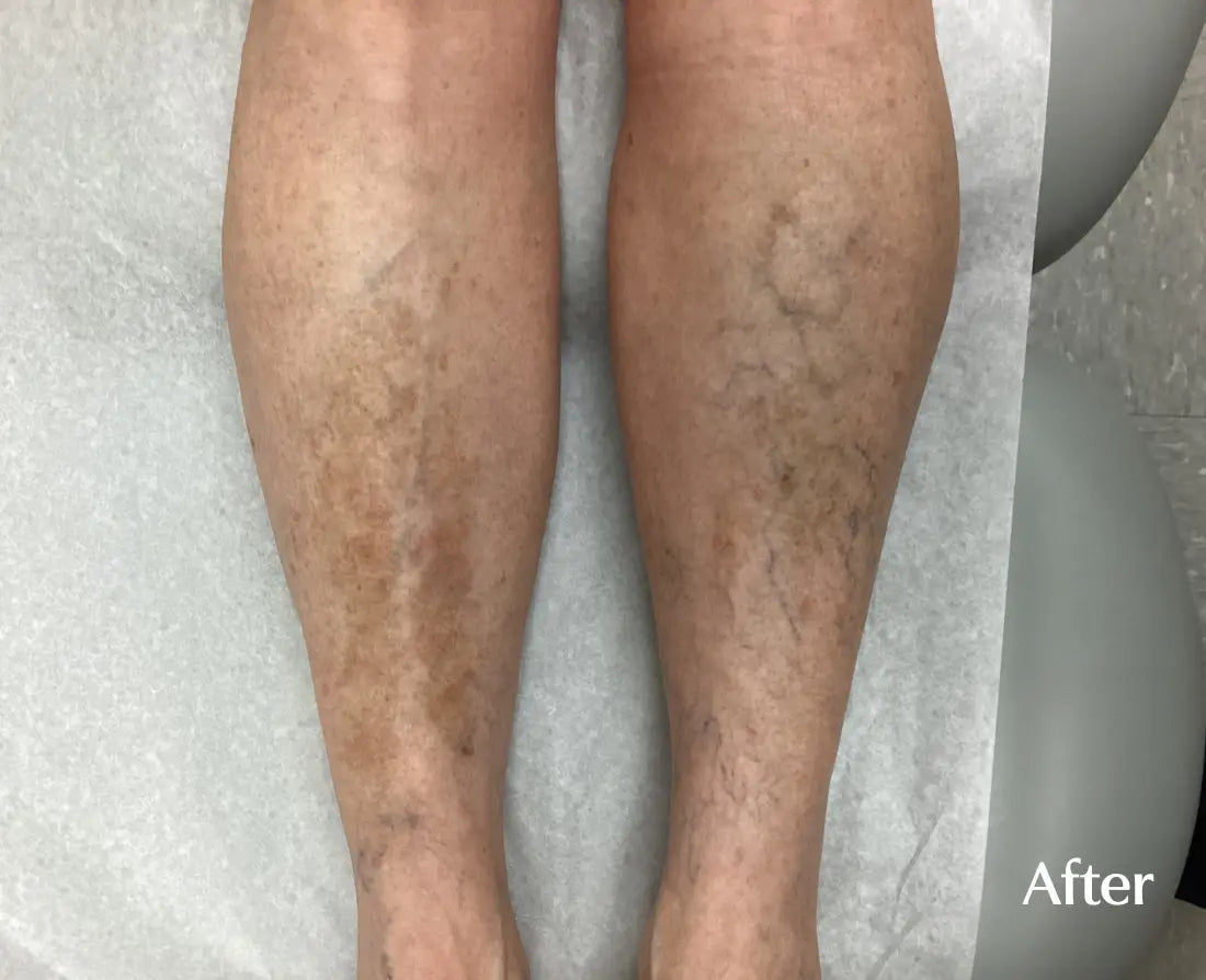 customer-leg-after.webp