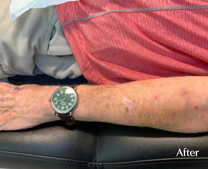 customer-purpura-arm-after.webp