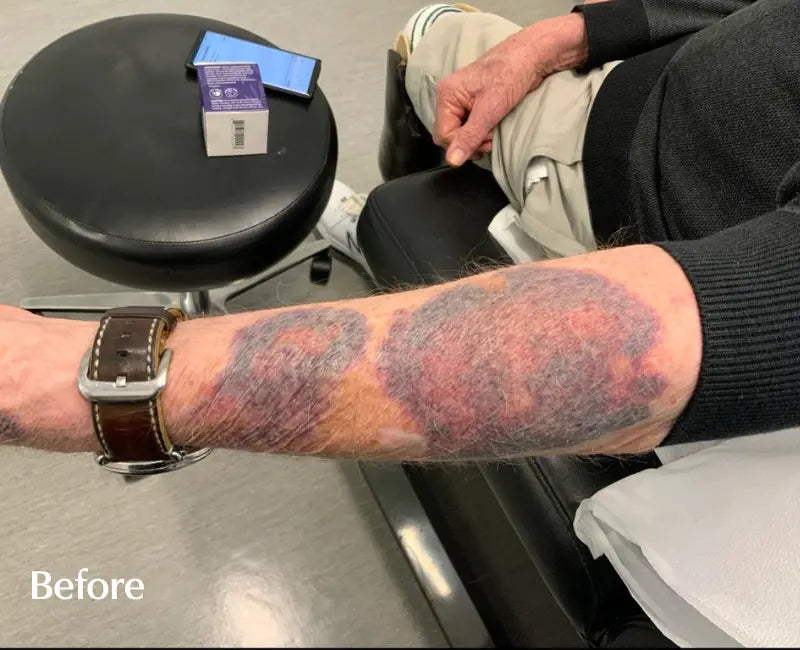 customer-purpura-arm-before.webp