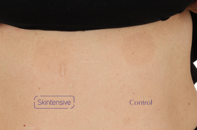 Skintensive Bruise Cream clinical trial Day 7 bruise image (after 1 week treatment)