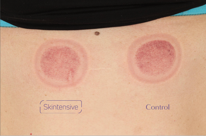 Skintensive Bruise Cream clinical trial Day 0 bruise image (before treatment)